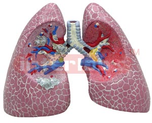 Diseased Lung